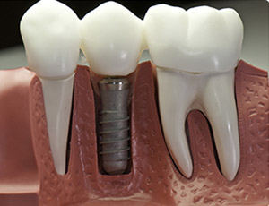 zobozdravstvo za odrasle, implantologija